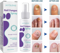 Extra Strong Nail Fungus Treatment Spray - 100ml